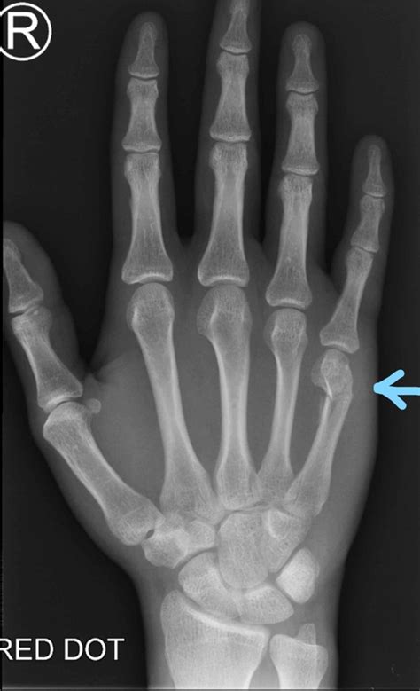 metal hand boxer|boxer's bone fracture.